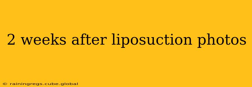 2 weeks after liposuction photos