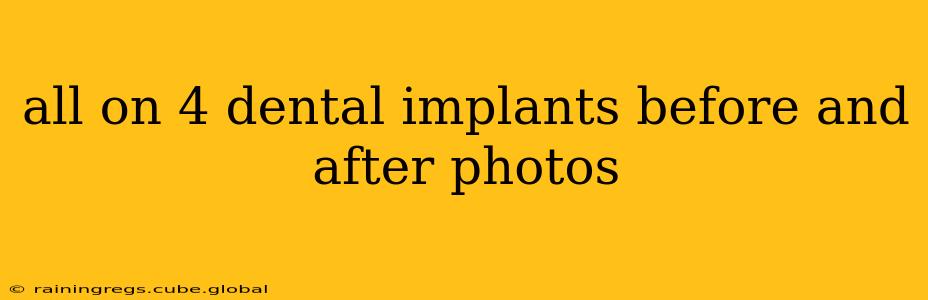 all on 4 dental implants before and after photos