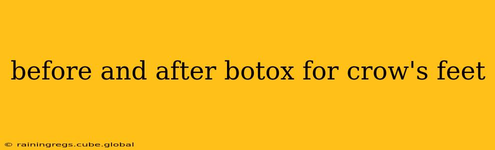 before and after botox for crow's feet