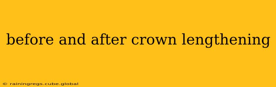 before and after crown lengthening