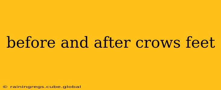 before and after crows feet