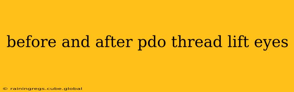 before and after pdo thread lift eyes