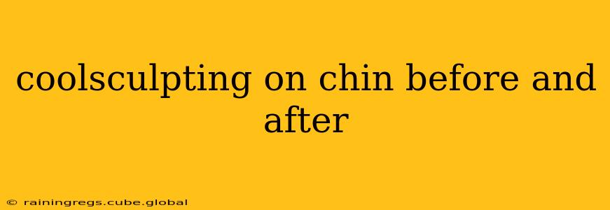 coolsculpting on chin before and after