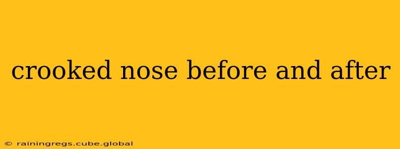 crooked nose before and after
