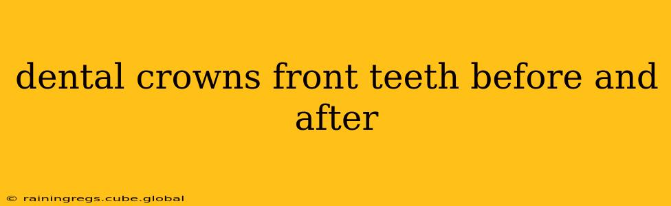 dental crowns front teeth before and after
