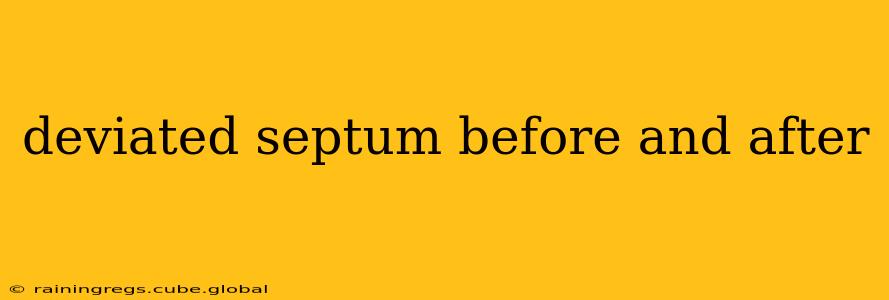 deviated septum before and after