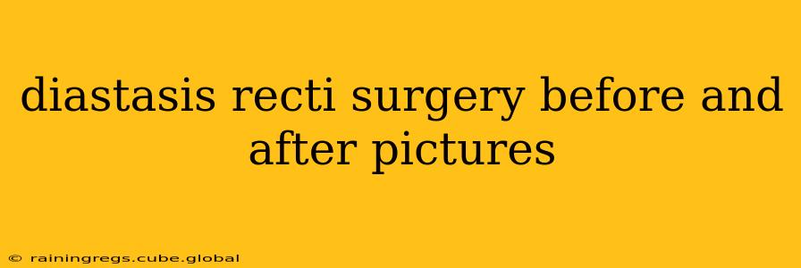 diastasis recti surgery before and after pictures