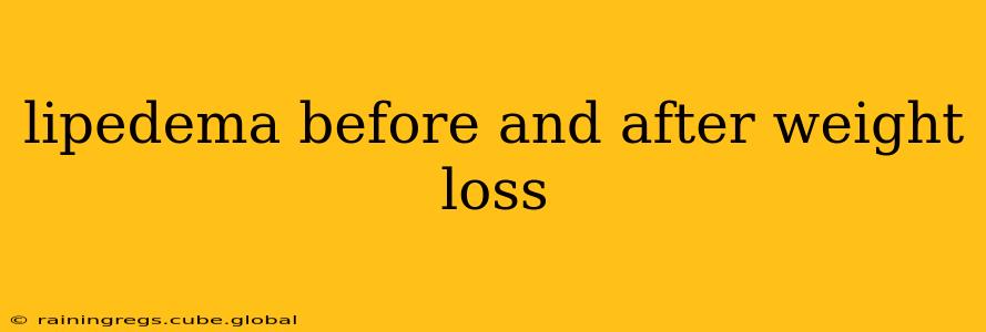 lipedema before and after weight loss