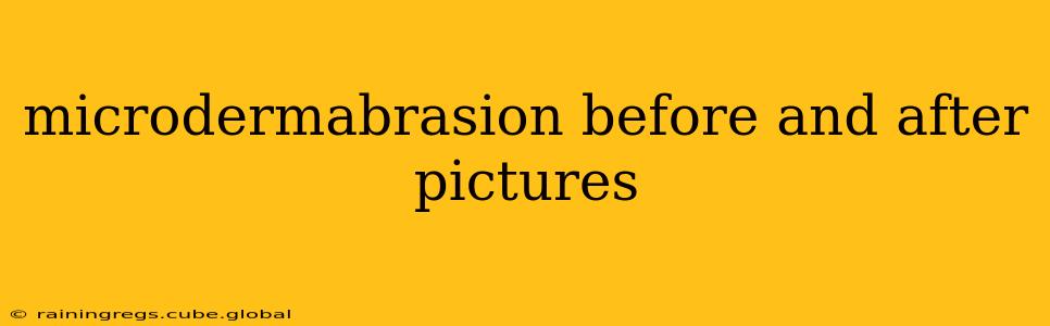 microdermabrasion before and after pictures