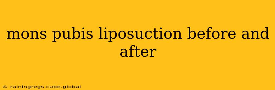 mons pubis liposuction before and after