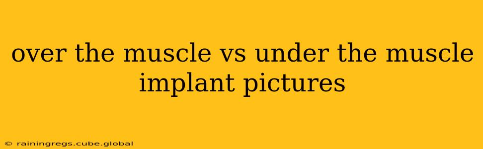 over the muscle vs under the muscle implant pictures