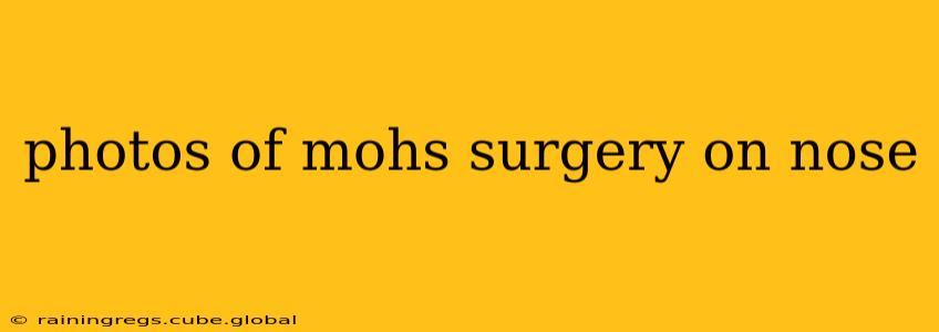photos of mohs surgery on nose