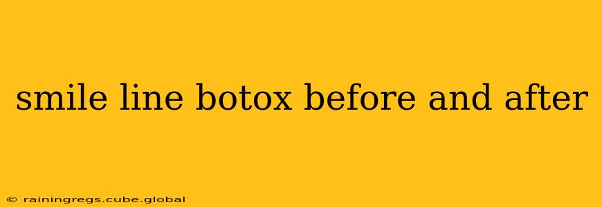 smile line botox before and after