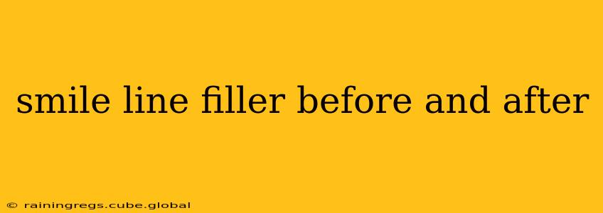 smile line filler before and after